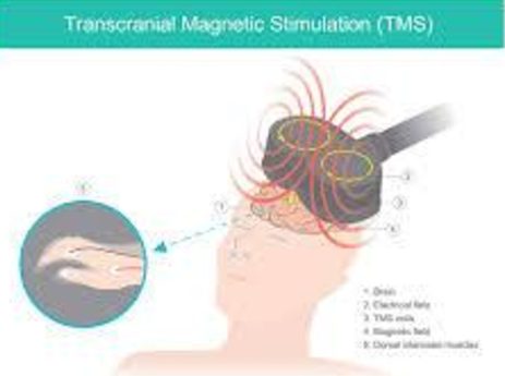 TMS Diagram